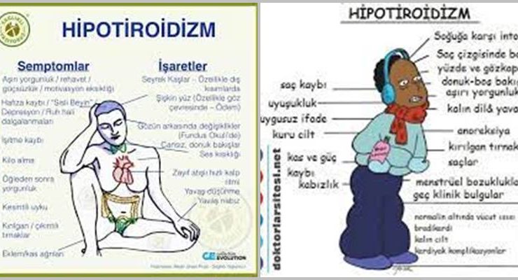 Hipotiroidizm nedir?