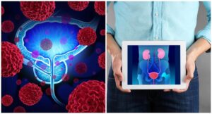 Prostat kanserinde yaşam kurtaran 4 öneri nelerdir?