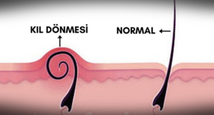 “Kıl dönmesi erkeklerde 3 kat daha fazla görülüyor”