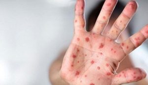Avrupa Komisyonu Sağlık Güvenliği Komitesi, Avrupa Hastalık Önleme ve Kontrol